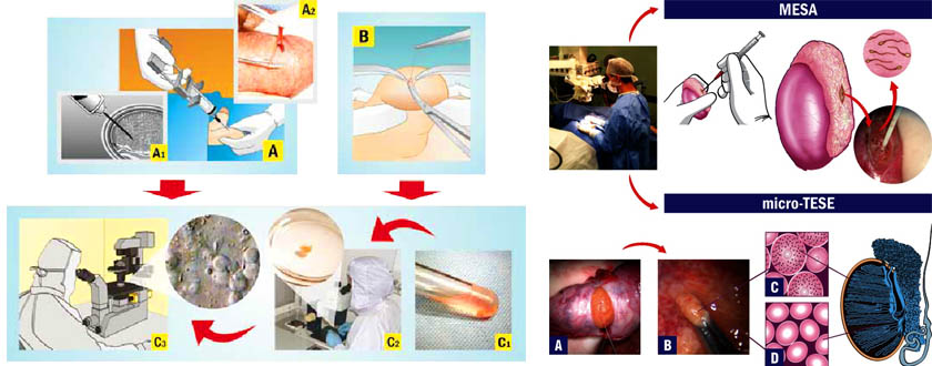 SPERM-RETTRIVAL-PROCEDURE